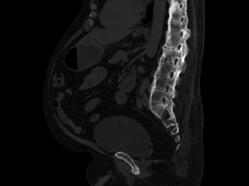 File:Ankylosing spondylitis (Radiopaedia 44609-48357 Sagittal bone window 61).jpg