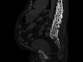 Ankylosing spondylitis (Radiopaedia 44609-48357 Sagittal bone window 62).jpg