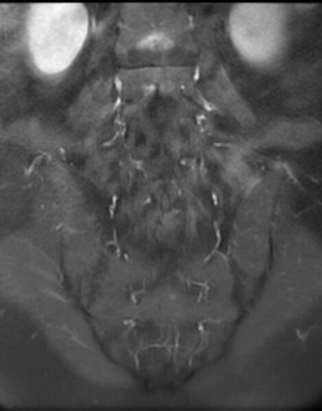 File:Ankylosing spondylitis - Andersson lesion (Radiopaedia 81878-95838 H 10).jpg