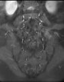 Ankylosing spondylitis - Andersson lesion (Radiopaedia 81878-95838 H 10).jpg
