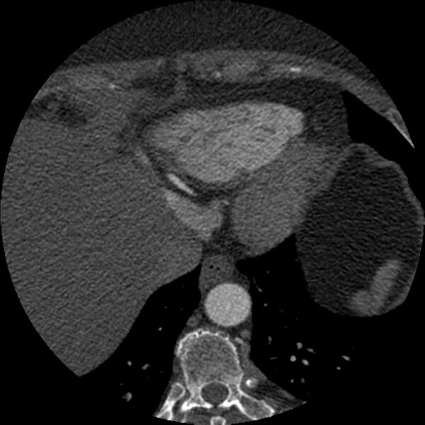 File:Anomalous origin of left circumflex artery from right coronary sinus (Radiopaedia 72563-83117 B 154).jpg