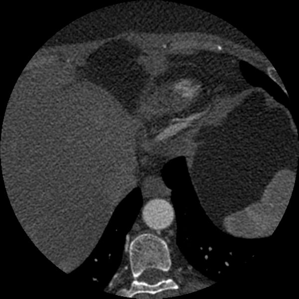 File:Anomalous origin of left circumflex artery from right coronary sinus (Radiopaedia 72563-83117 B 166).jpg