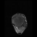 Anterior calcaneal process fracture (Radiopaedia 74654-85611 Axial PD fat sat 2).jpg