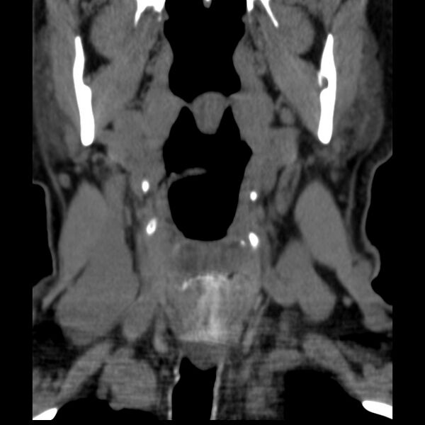 File:Anterior cervical postdiscectomy arthrodesis (Radiopaedia 32678-33646 Coronal non-contrast 1).jpg
