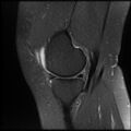Anterior cruciate ligament tear, Wrisberg rip and bucket-handle tear of medial meniscus (Radiopaedia 75872-87266 Sagittal PD fat sat 20).jpg