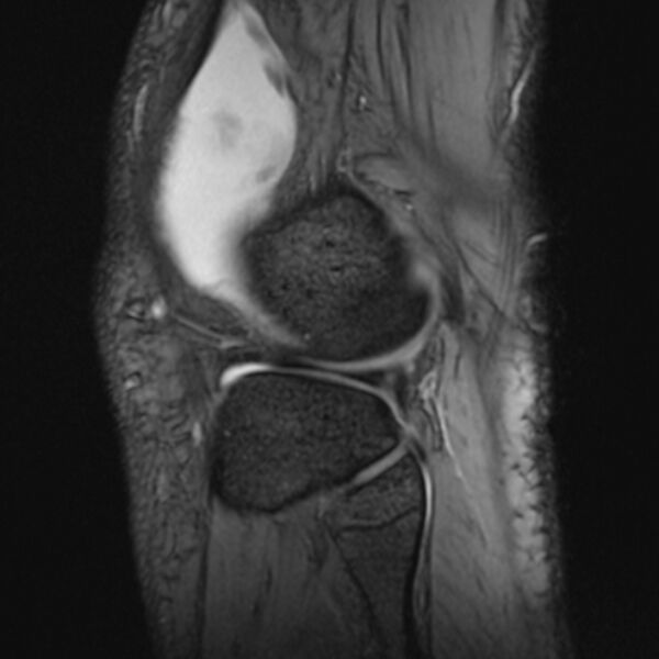 File:Anterior cruciate ligament tear - ramp lesion (Radiopaedia 71883-82322 Sagittal T2 fat sat 5).jpg