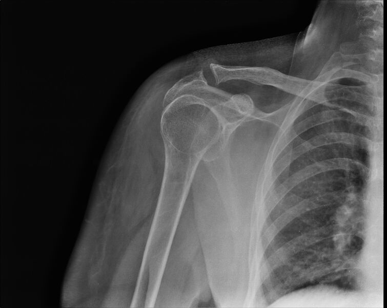 File:Anterior shoulder dislocation - ultrasound (Radiopaedia 23060-23092 Frontal 1).jpg