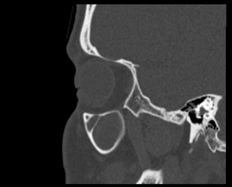 File:Antrochoanal polyp (Radiopaedia 21894-21868 Sagittal bone window 5).jpg