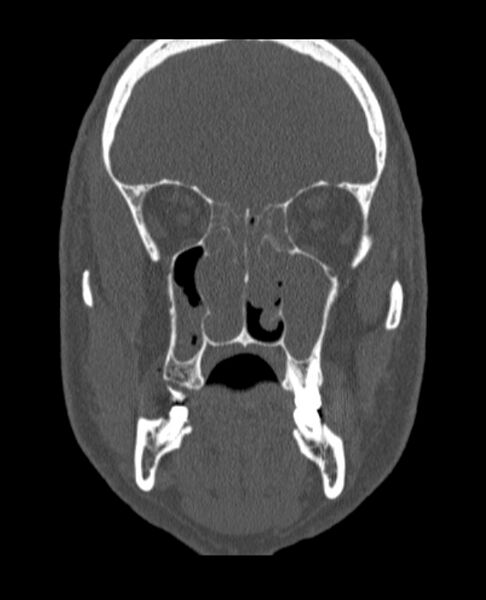 File:Antrochoanal polyp (Radiopaedia 79011-92169 Coronal bone window 43).jpg