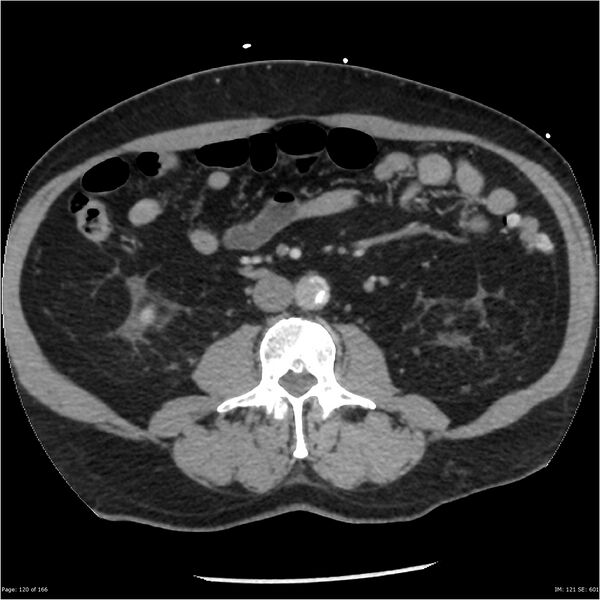 File:Aortic dissection- Stanford A (Radiopaedia 37759-39664 A 111).jpg