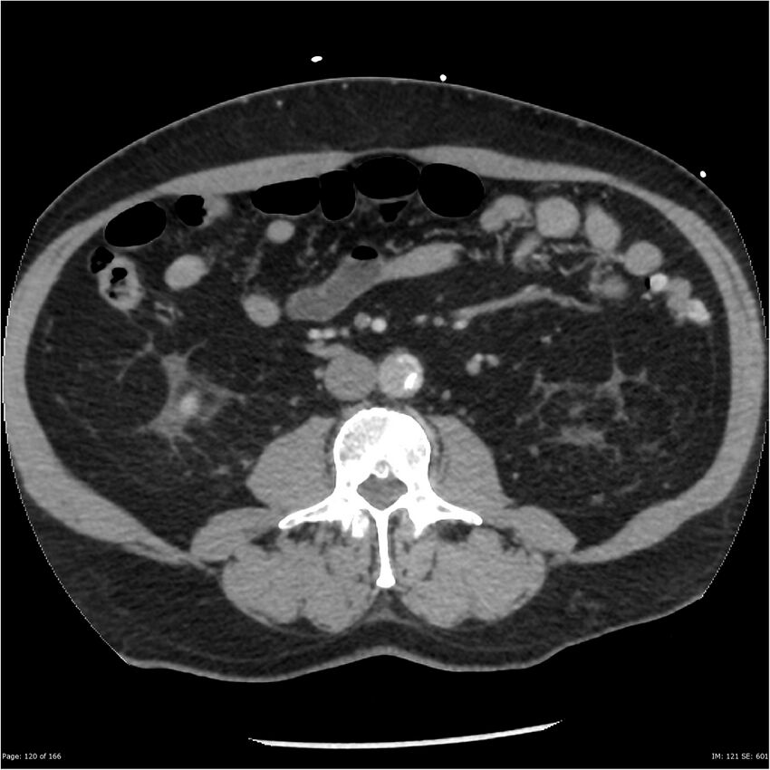 Aortic dissection- Stanford A (Radiopaedia 37759-39664 A 111).jpg