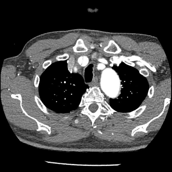 File:Aortic dissection - DeBakey Type I-Stanford A (Radiopaedia 79863-93115 A 5).jpg