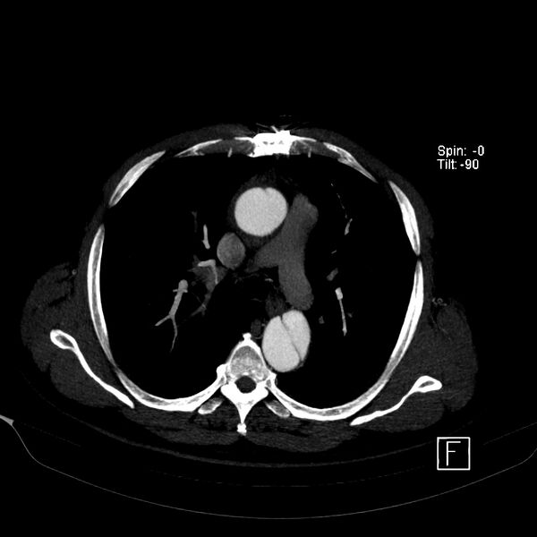 File:Aortic dissection - De Bakey type III - Stanford B (Radiopaedia 21903-21882 B 23).jpg
