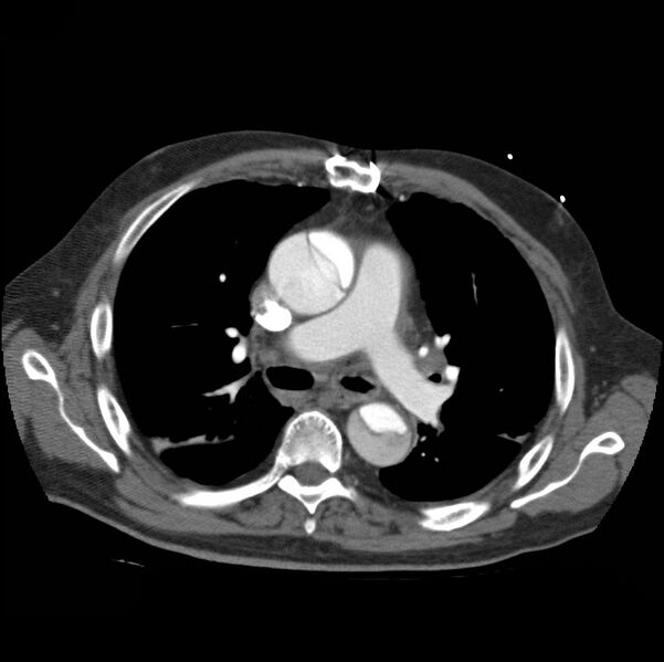 File:Aortic dissection with rupture into pericardium (Radiopaedia 12384-12647 A 24).jpg