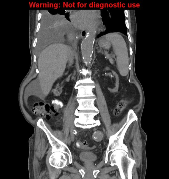 File:Aortic graft infection (Radiopaedia 44979-48907 non-contrast 30).jpg