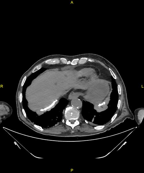 File:Aortoenteric fistula (Radiopaedia 84308-99603 Axial non-contrast 20).jpg