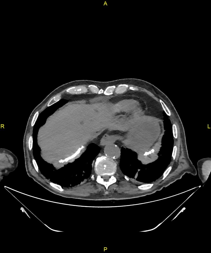 Aortoenteric fistula (Radiopaedia 84308-99603 Axial non-contrast 20).jpg