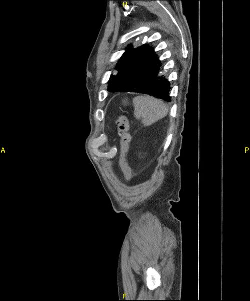 File:Aortoenteric fistula (Radiopaedia 84308-99603 C 305).jpg