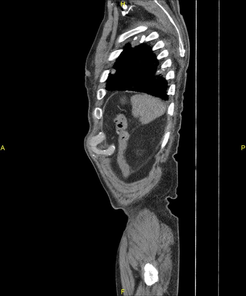 Aortoenteric fistula (Radiopaedia 84308-99603 C 305).jpg