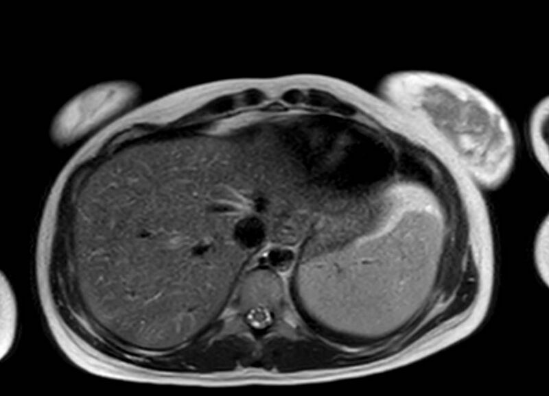 File:Appendicitis in gravida (MRI) (Radiopaedia 89433-106395 Axial T2 5).jpg