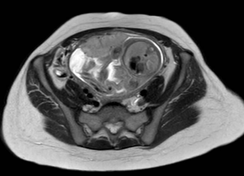 File:Appendicitis in gravida (MRI) (Radiopaedia 89433-106395 Axial T2 51).jpg