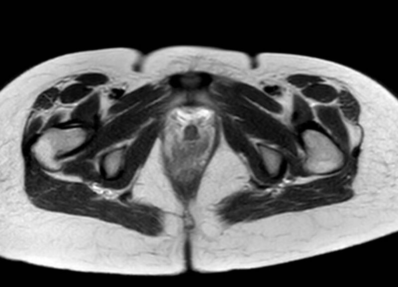 File:Appendicitis in gravida (MRI) (Radiopaedia 89433-106395 Axial T2 71).jpg