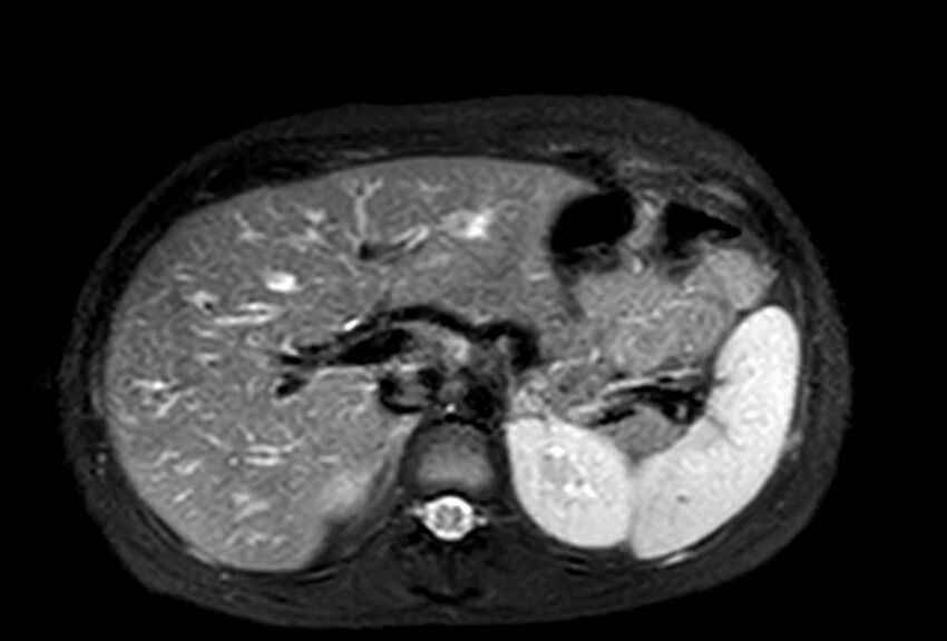 Appendicitis in gravida (MRI) (Radiopaedia 89433-106395 Axial T2 SPAIR 19).jpg