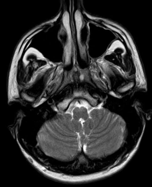 File:Arachnoid cyst- extremely large (Radiopaedia 68741-78451 Axial T2 5).jpg
