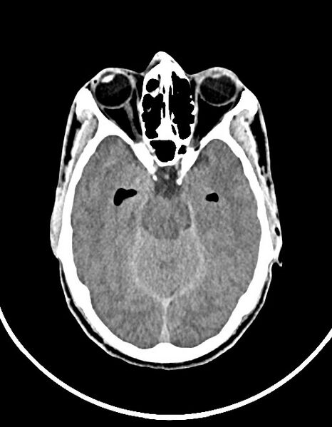 File:Arrow injury to the brain (Radiopaedia 72101-82607 Axial non-contrast 64).jpg