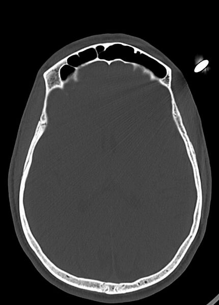 File:Arrow injury to the head (Radiopaedia 75266-86388 Axial bone window 76).jpg