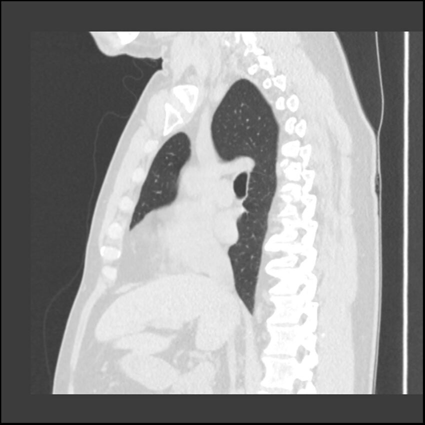 Asbestosis (Radiopaedia 45002-48961 Sagittal lung window 75).jpg