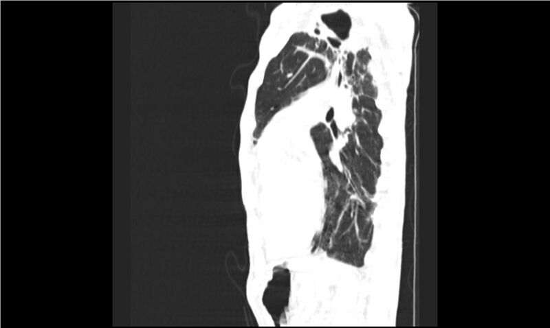 File:Aspergilloma (Radiopaedia 20788-20701 Sagittal lung window 7).jpg