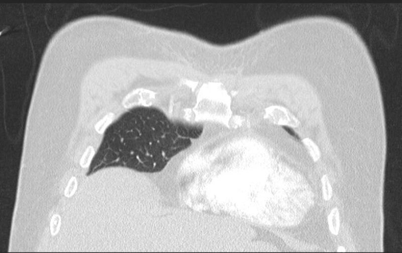 File:Aspirated tooth (Radiopaedia 28584-28844 Axial lung window 31).jpg