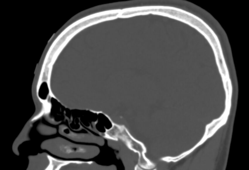 Asymptomatic occipital spur (Radiopaedia 87753-104201 Sagittal bone window 132).jpg
