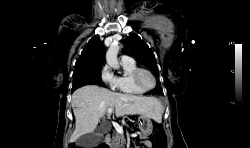 File:Atypical dissection of the thoracic aorta (Radiopaedia 10975-78320 B 3).jpg