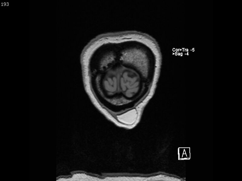 File:Atypical meningioma - intraosseous (Radiopaedia 64915-74572 Coronal T1 193).jpg