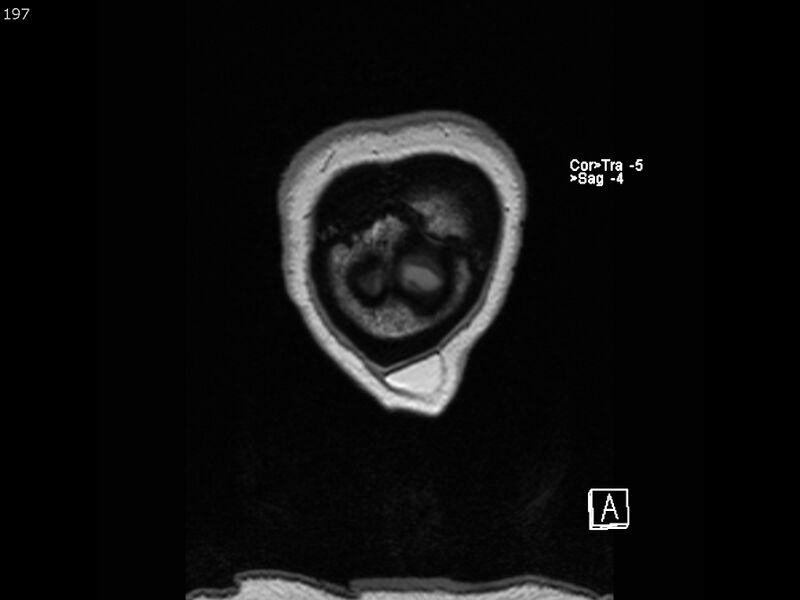 File:Atypical meningioma - intraosseous (Radiopaedia 64915-74572 Coronal T1 197).jpg