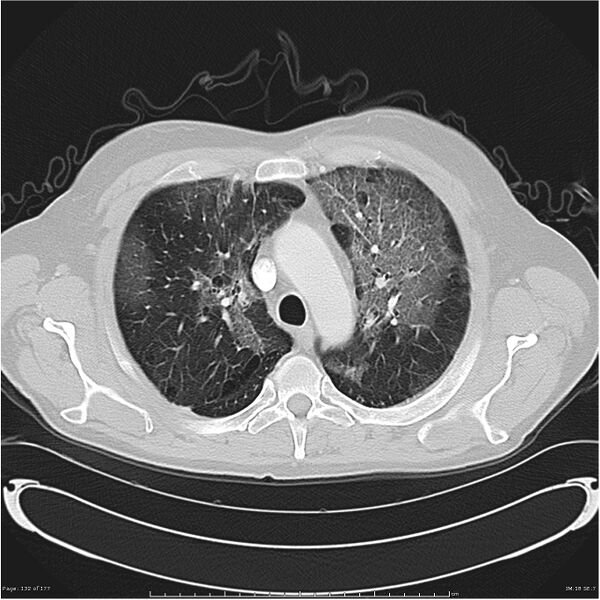 File:Atypical pneumonia - Q fever (Radiopaedia 21993-21989 lung window 11).jpg