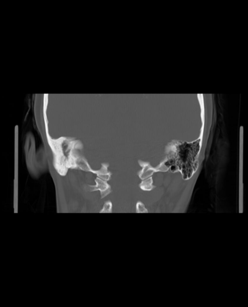 Automastoidectomy with labyrinthine fistula (Radiopaedia 84143-99411 Coronal non-contrast 108).jpg