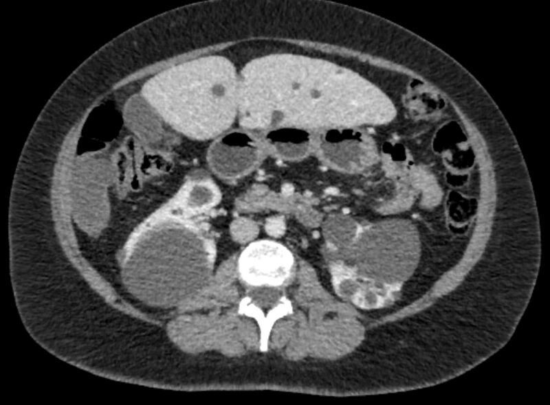 File:Autosomal dominant polycystic kidney disease (Radiopaedia 57124-64017 A 56).jpg