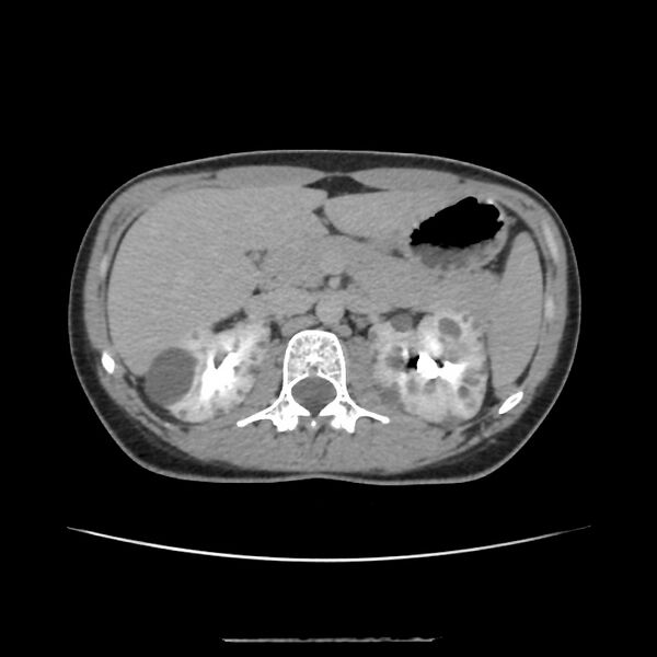 File:Autosomal dominant polycystic kidney disease - early onset (Radiopaedia 40734-43387 D 5).jpg