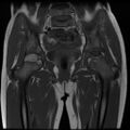 Avascular necrosis of the hip (Radiopaedia 29563-30067 Coronal T1 8).jpg