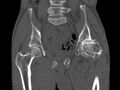 Avascular necrosis of the left hip (Radiopaedia 75068-86125 Coronal bone window 32).jpg