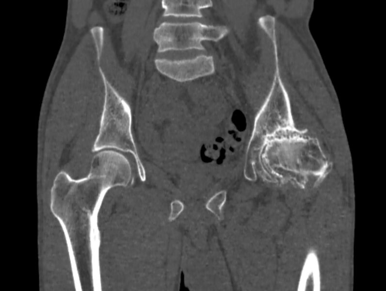 File:Avascular necrosis of the left hip (Radiopaedia 75068-86125 Coronal bone window 32).jpg