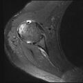 Avulsion fracture - greater tuberosity of humerus (Radiopaedia 71216-81515 Axial PD fat sat 7).jpg
