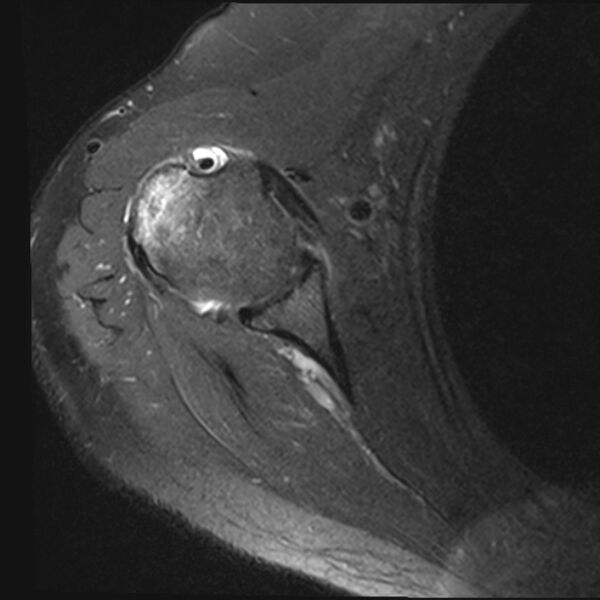 File:Avulsion fracture - greater tuberosity of humerus (Radiopaedia 71216-81515 Axial PD fat sat 7).jpg