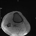 Avulsion fracture of the fibular head (Radiopaedia 74804-85808 Axial PD fat sat 40).jpg