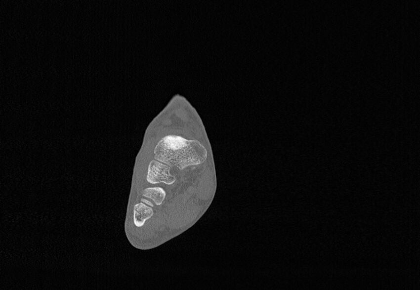 Avulsion fractures of talus and calcaneus (Radiopaedia 48277-53155 Coronal bone window 33).jpg