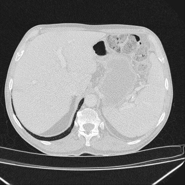 File:Azygos lobe (Radiopaedia 38259-40275 Axial lung window 79).jpg