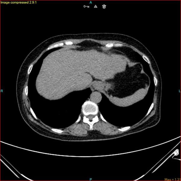File:Azygos vein aneurysm (Radiopaedia 77824-90130 A 46).jpg